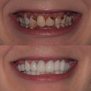 Smile Makeover